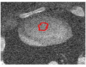 Figure 1 is a an original cortex image. Figure 2 is the original image in Figure 1 with added Gaussian noise