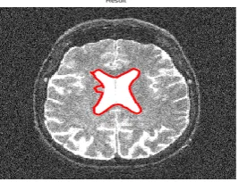 Fig -16:   Segmented noisy cardia image with proposed method with parameters alpha and beta 0.5 & kappa and gamma 1
