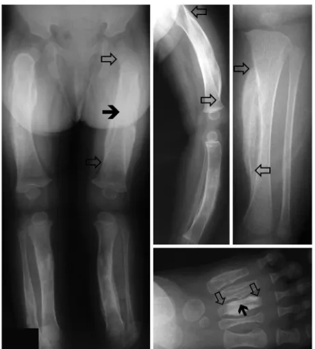 Figure 1Radiographic features of infantile cortical hyperostosis. Radiographs 