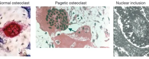 Figure 3Osteoclasts in normal bone and in Paget’s disease. (