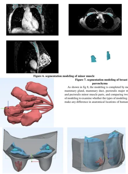 Figure 6. segmentation modeling of minor muscle Figure 7. segmentation modeling of breast 