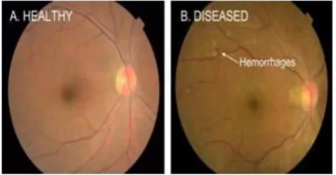 Fig. 1 Sample digital fundus image with a Micro Aneurysm (MA) 