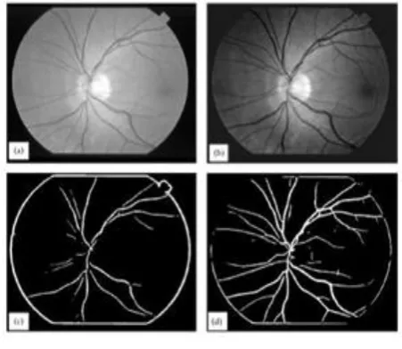 Fig. 2 Vessel Removal 