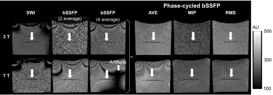 Figure 4 comparison of sWI and bssFP images of phantom with ~1,000 labeled cells at 3 T (top row) and 7 T (bottom row).Notes: The original bssFP images show banding artifacts which are suppressed in combined phase-cycled aVe, MIP, and rMs images