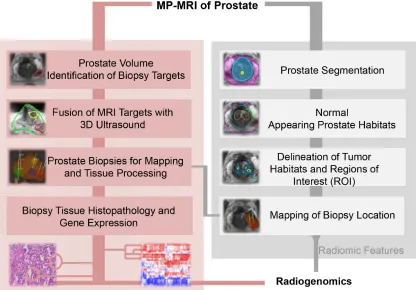 Figure 2: Delineation of biopsy targets on mpMRI and fusion of targets on 3D TRUS. A. Screenshots from ProFuse software (Eigen, Grass Valley, CA) for fusion of mpMRI delineated prostate Regions of Interest (ROIs) for targeted biopsy