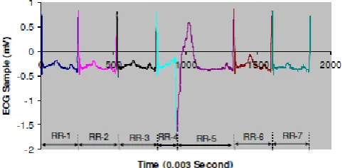 Figure 7: Loss of ECG Signals   