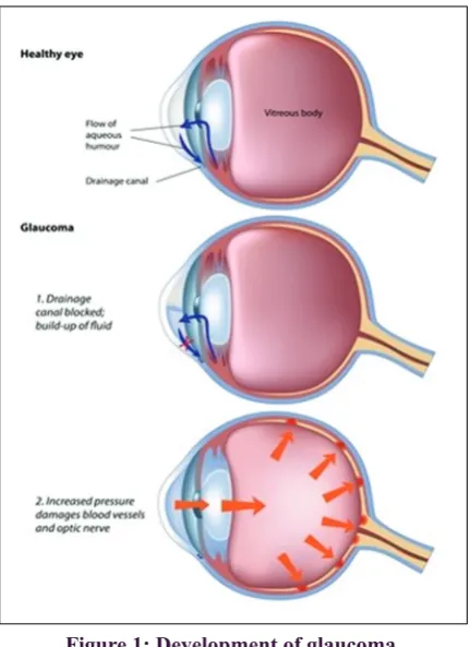 Figure 1: Development of glaucoma.