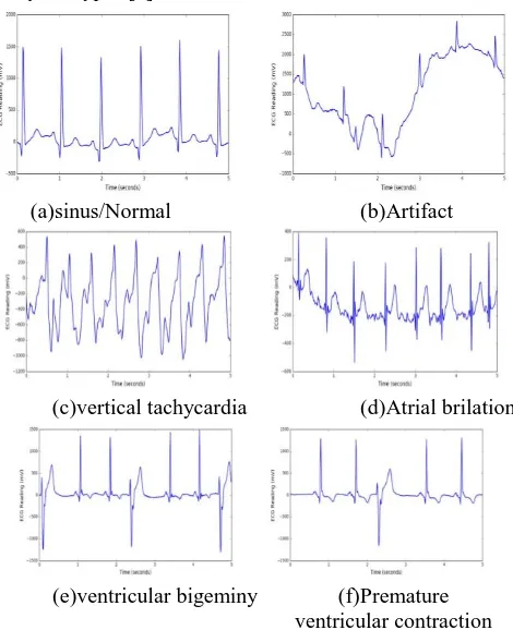 Figure :1.1 Examples of rhythm types ventricular contraction One-class Support Vector Machines (OC-SVM) Scholkopf¨ 