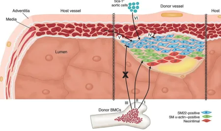 Figure 1What are the true origins of the SMCs present in the intimal lesions of TA? Hu et al
