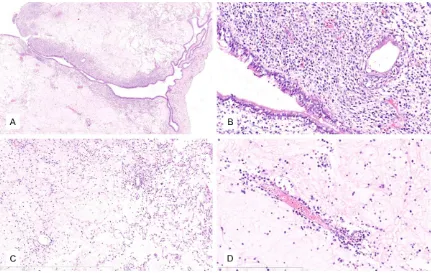 Figure 2. H&E staining. A. At low magnification, the tumor was in polypoid-growth configuration, covered with pseu-dostratified ciliated columnar epithelium, and epithelial  cell  shedding was observed in small part of the tumor surface