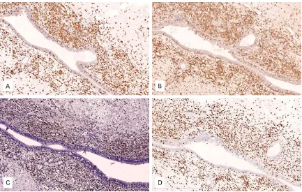 Figure 3. Immunohistochemical staining and in situ hybridization. A. Immunohistochemistry for cytoplasmic CD3ε showed that a significant number of cells are positive