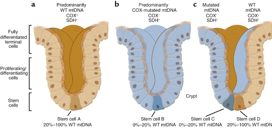 Figure 2Two-color histochemistry for SDH and COX reveals three types of crypts, with normal (a), deficient (b), and “mosaic” (c) patterns of mito-