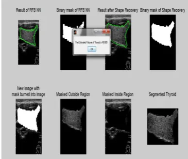 Fig 5:  Detection of thyroid region  