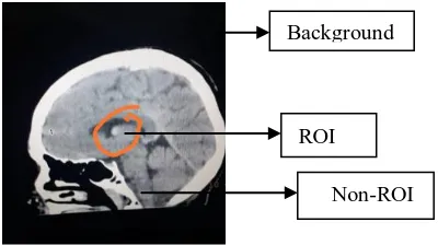 Figure 1 shows the Region of interest and background. The above figure given is the image of the CT scan of a patient having a tumor in brain, which is visible as a small dot like structure, which is marked as ROI