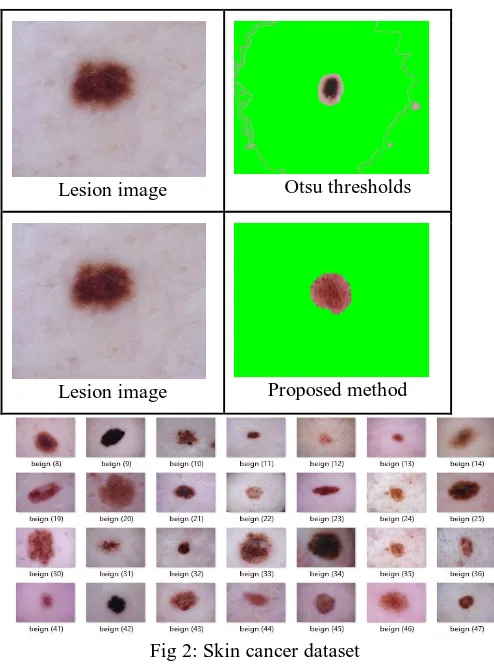 Fig 2: Skin cancer dataset  An initial step is that of Dermoscopy images as the dataset 