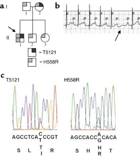 Figure 1 Genotype and ECG phenotype. (conduction block with normal QT and QRS durations