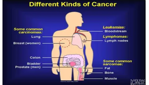 Fig -4: Types of cancer  