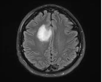Figure 1 Brain Tumor MRI image 