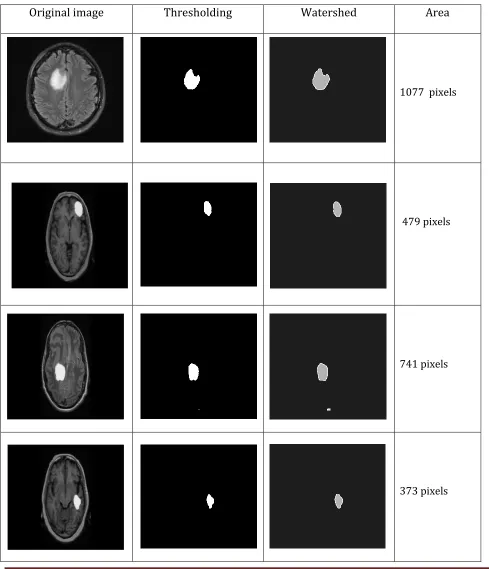 Table 1 segmented brain tumor images 