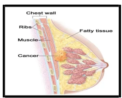 Fig. 1:Representing Cancerous Tissues and Fatty Tissues 