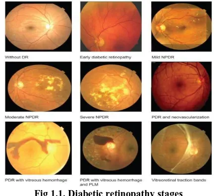 Fig 1.1. Diabetic retinopathy stages 