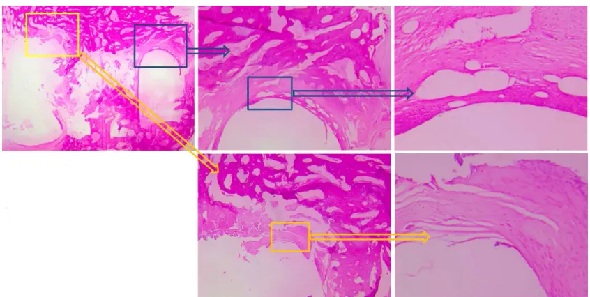 Figure 5 Foreign body reactions of the bioabsorbable implants were graded histologically according to the hoffmann score