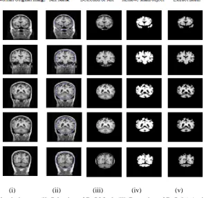 Fig  2: (i) Normal MRI brain images (ii) Selection of RoI Mask (iii) Detection of RoI (iv) Artifacts Removed Brain  images (v) Segmented by TMOS 