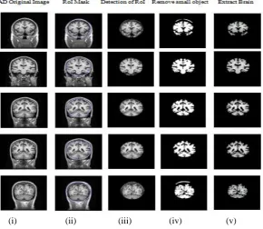 Fig. 3: (i) AD MRI brain images (ii) Selection of RoI Mask (iii) Detection of RoI (iii)  