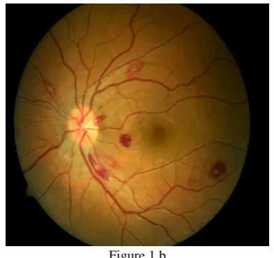 Figure 1 b Figure 1 b. DR Fundus image with Hemorrhages.  