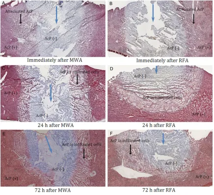 Figure 2. Low magnification (10×) images of MWA and RFA samples stained with AcP. Blue arrows indicate the needle insertion sites