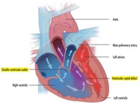 Figure 1.3.3: Double Outlet Right Ventricle Heart Structure 