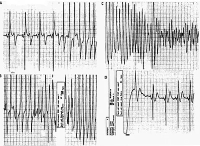 Figure 2.4. Stored ICD electrogram showing ventricular fibrillation being converted to sinus  rhythm following a shock