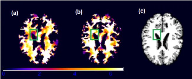 Figure 2.4: White matter RAVENS map for two randomly selected children from the ADHD study