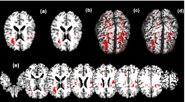 Figure 2.7: ADHD data analysis results. Top panels: significant regions in the brain where there exists a morphological difference between children with ADHD and children who do not have the disorder, based on a 95% credible interval