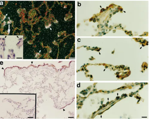 Figure 3. Matrilysin is induced in type II pneumocytes in CF. (a) In sections of human lung from patients with CF processed for in situ hybridiza-