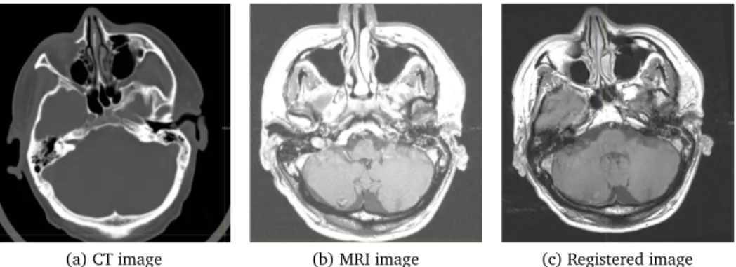 Figure 1.2: Example of CT-MRI registration for target-volume delineation of brain tumors.