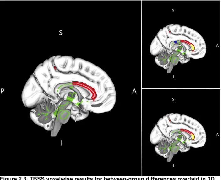 Figure 2.3. TBSS voxelwise results for between-group differences overlaid in 3D  MNI brain template shown in sagittal view, highlighting the corpus callosum