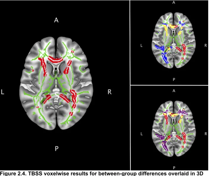 Figure 2.4. TBSS voxelwise results for between-group differences overlaid in 3D  MNI brain template shown in axial view, highlighting the corpus callosum and  internal capsule