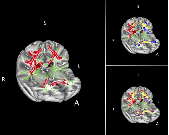Figure 2.5. TBSS voxelwise results for between-group differences overlaid in 3D  MNI brain template shown in axio-coronal view, highlighting the corticospinal  tracts