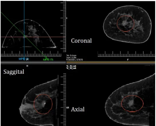 Figure 1. Breast computed tomography images of a 44-year-old woman with a palpable mass in the upper central left breast diagnosed with invasive ductal cancer, grade I