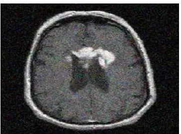 Fig. 3 Ideal MRI Image of a brain with tumor without noise 