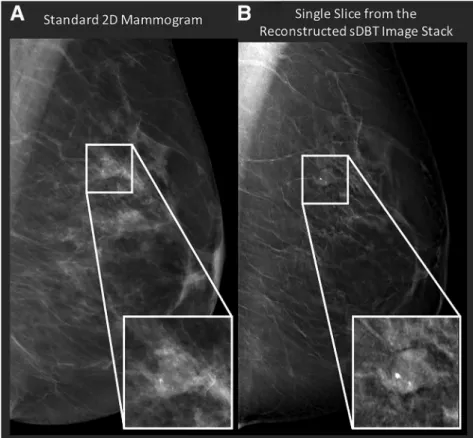 Figure 7. Example mammogram (A) and image slice from the reconstructed stationary digital breast tomosynthesis (sDBT) image stack (B)