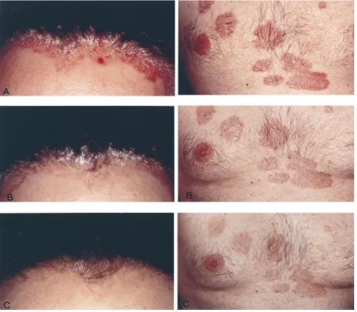 Figure 5. Marked systemic antipsoriatic effect of intralesional IL-10 administration in patient F