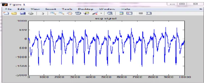 Table  1  shows  the  obtained  accuracy,  sensitivity  and  specificity  from  lead  III  based  on  KNN  based  ECG  classification