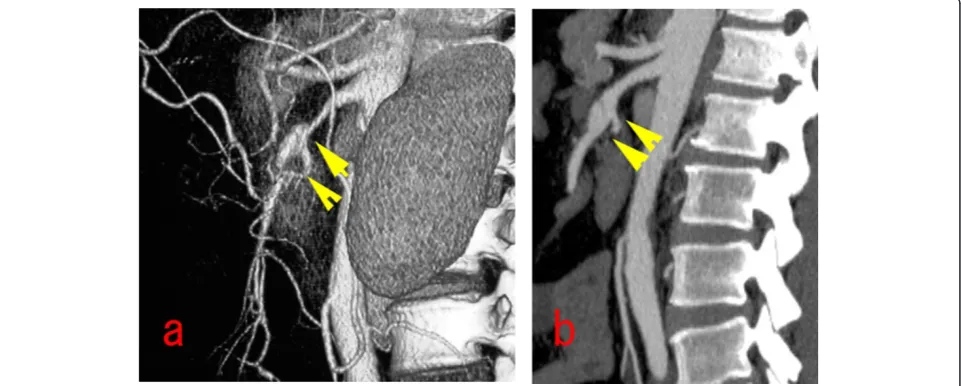 Figure 3 Sakamoto’s type III dissection of the SMA. (a) preoperative three-dimensionally reconstructed images showing severe stenosis ofthe SMA with ULP, and the collateral flow from the celiac artery and inferior mesenteric artery