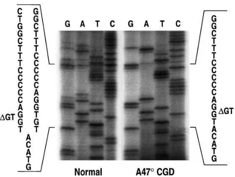 Figure 1. Sequence analysis of the intron 1/exon 2 border of p47-phox. Genomic DNA samples from a normal individual and a A47� CGD patient were amplified with primers 2LB (CTTTCTGCAATC-CAGGACAA) and 2RB (ATCACCTGGGCTAAGGTCCT) and sequenced with the primer 