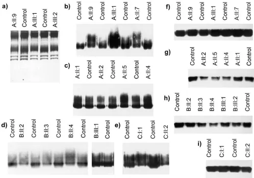 Figure 5. SDS-PAGE of membranes and band 3 from the families A, B, and C. (mal controls