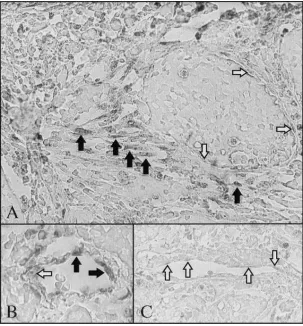 Figure 3. Pulmonary KS tissue samples processed for in situ PCR in the presence or absence ofHHV-8 primers (limited digestion conditions with trypsin)