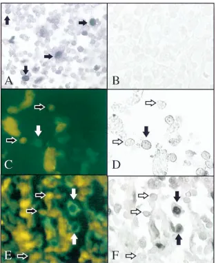Figure 4. AIDS-related BCBL processed for in situ PCR in the presence or absence of HHV-8 primers