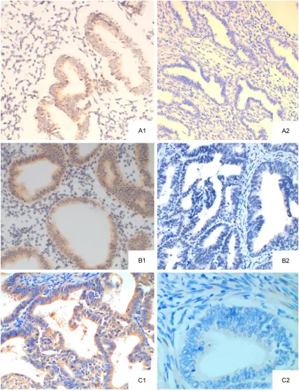 Figure 1. GPR30 protein expression (SP method; ×20). A: normal endometrium; A1: GPR30 positive; A2: GPR30 negative; B: EAH; B1: GPR30 positive; B2: GPR30 negative; C: EEC; C1: GPR30 positive; C2: GPR30 negative
